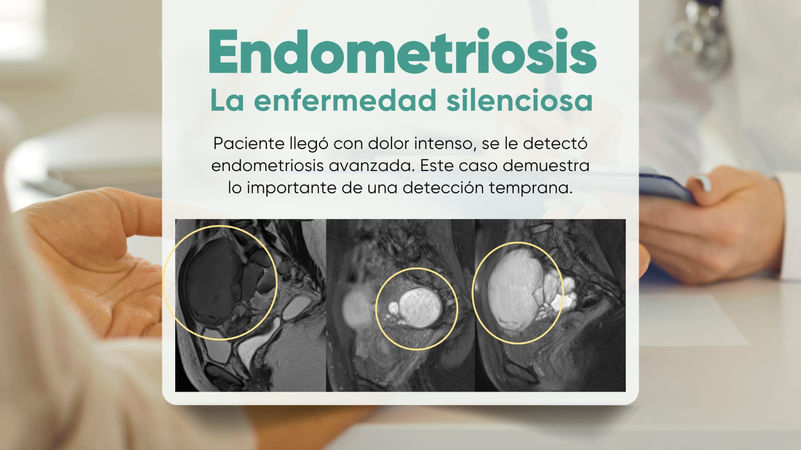 Endometriosis La enfermedad silenciosa que muchas mujeres padecen sin saberlo