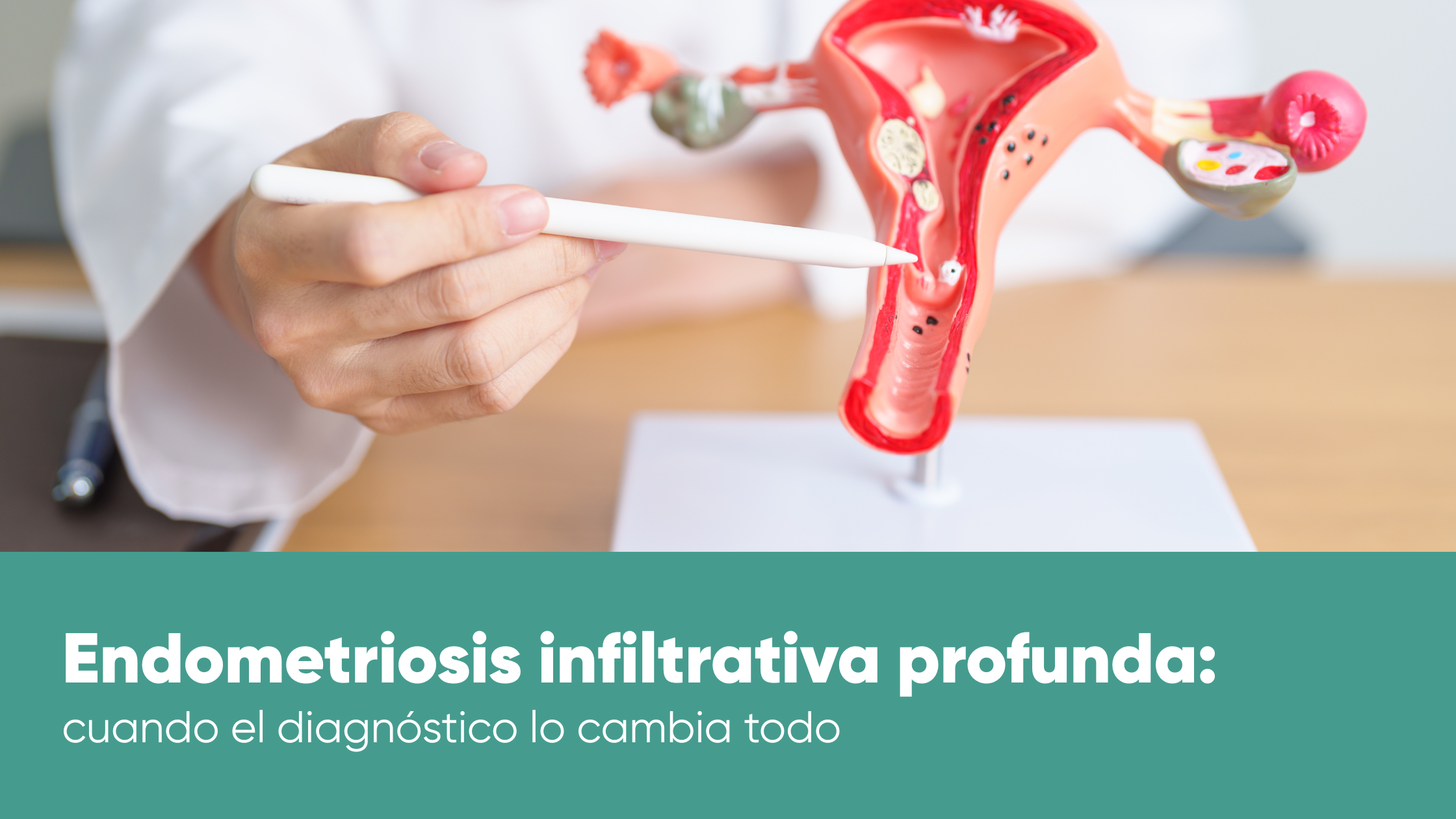 Endometriosis infiltrativa profunda: cuando el diagnóstico preciso marca la diferencia