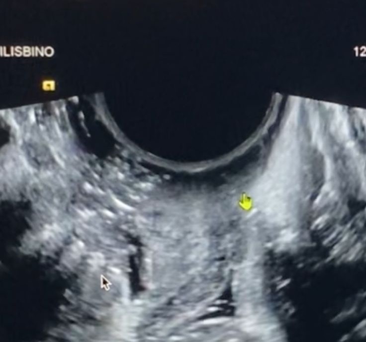Ultrasonido endovaginal